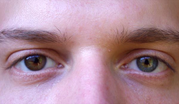 Heterocromia: a beleza dos olhos bicolor